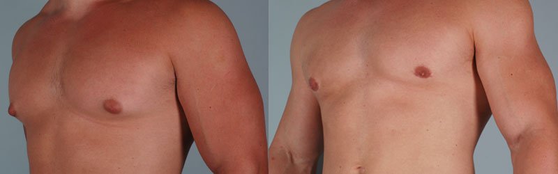 breast reduction boston Male chastity cock cuff
