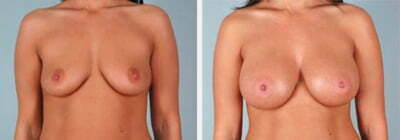 Breast-Augmentation-Saline-Quincy-MA