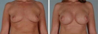 Breast-Augmentation-Silicone-Quincy-MA