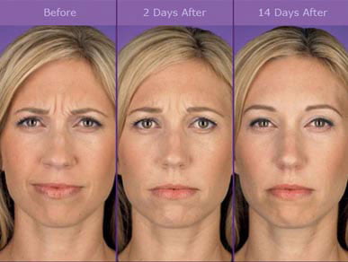 botox before and after photos