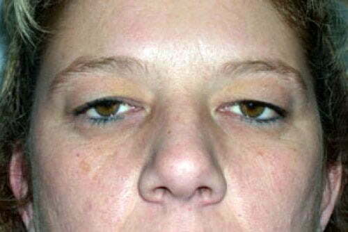 Eyelid Surgery Patient 100