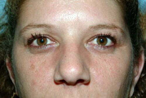 Eyelid Surgery Patient 100