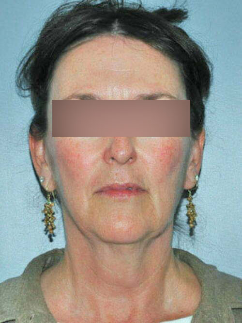 Facelift Patient 102