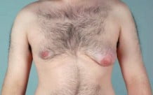 Male Breast Reduction Patient 106