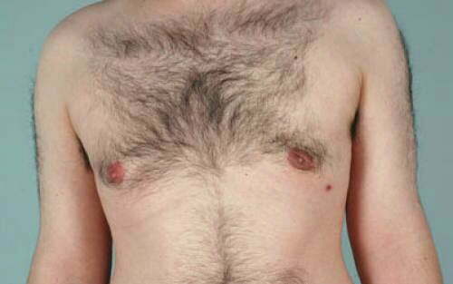 Male Breast Reduction Patient 106