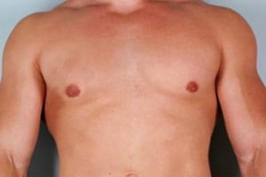 Male Breast Reduction Patient 107
