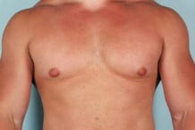 Male Breast Reduction Patient 107