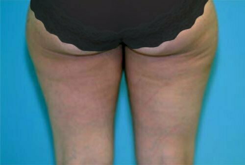 Liposuction Patient 109