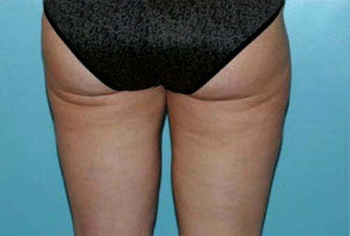 Liposuction Patient 109