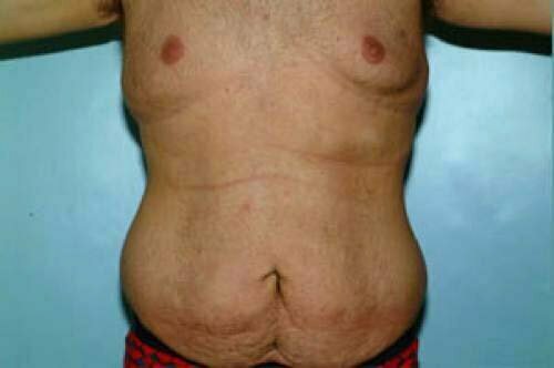 Tummy Tuck Patient 111