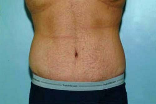 Tummy Tuck Patient 111