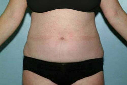 Liposuction Patient 112