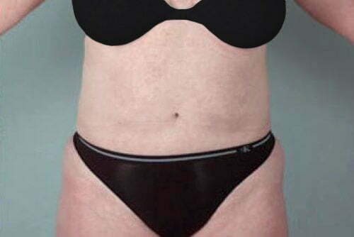 Liposuction Patient 112
