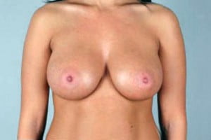 Breast Augmentation Patient 113