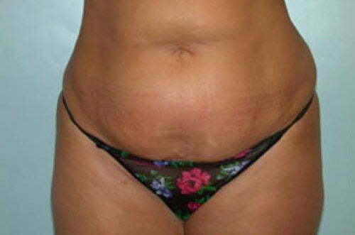 Tummy Tuck Patient 118