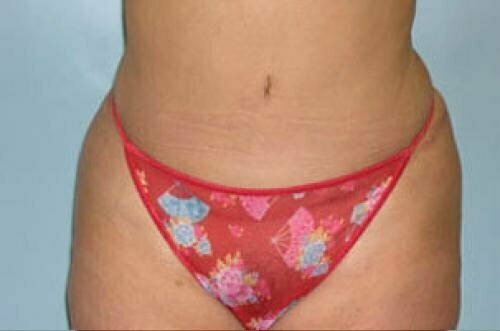 Tummy Tuck Patient 118