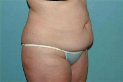 Tummy Tuck Patient 119