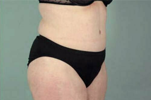 Tummy Tuck Patient 119
