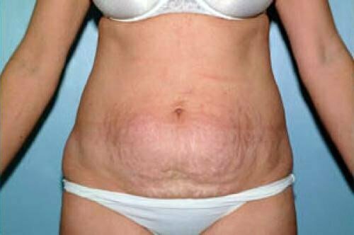 Tummy Tuck Patient 126