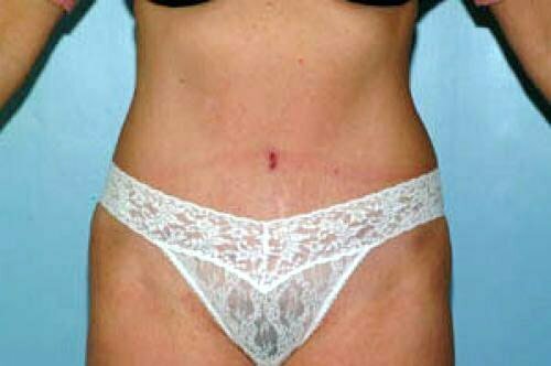 Tummy Tuck Patient 126
