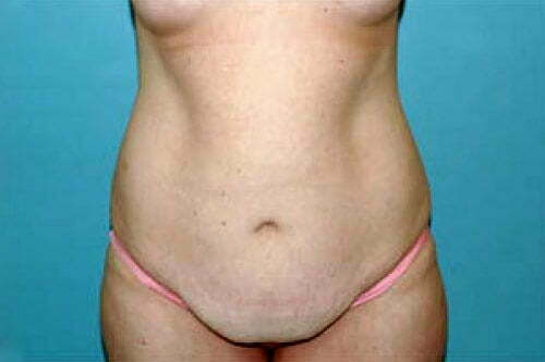Tummy Tuck Patient 127