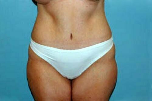 Tummy Tuck Patient 127
