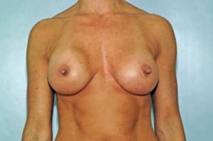 Breast Augmentation Patient 134
