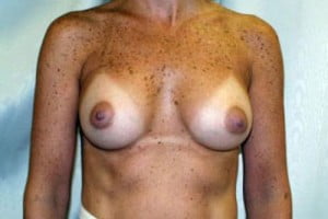 Breast Augmentation Patient 143