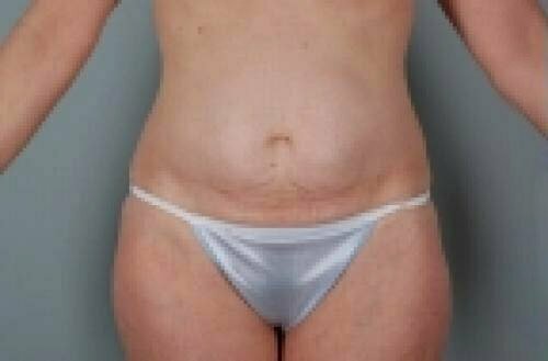 Tummy Tuck Patient 144