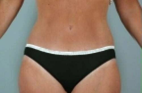 Tummy Tuck Patient 144
