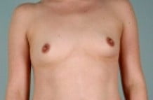 Breast Augmenation Patient 149