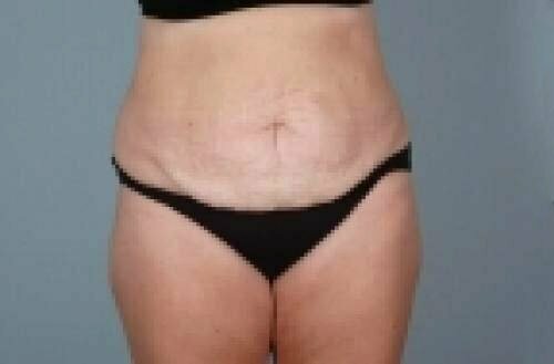 Tummy Tuck Patient 156