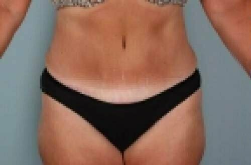 Tummy Tuck Patient 156