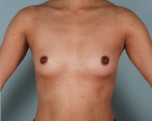 Breast Augmentation Patient 164