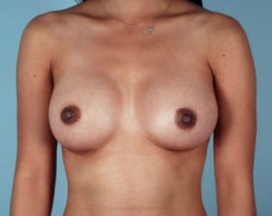 Breast Augmentation Patient 164