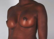 Breast Augmentation Patient 165