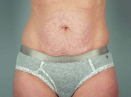 Tummy Tuck Patient 167