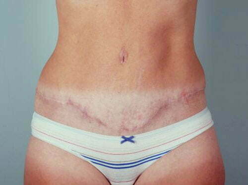 Tummy Tuck Patient 167