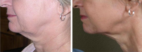 Skin-Tightening-boston-2