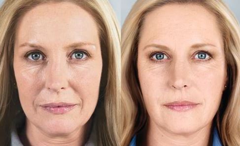 sculptra before after