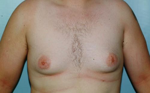 Male Breast Reduction Patient 105