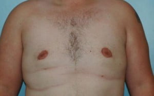 Male Breast Reduction Patient 105