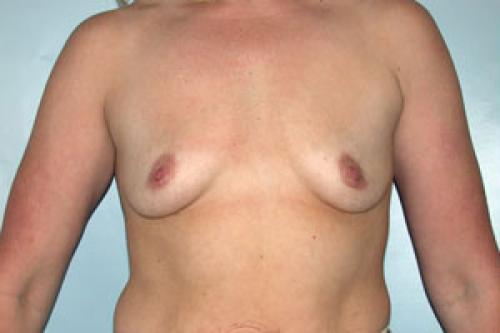 Breast Augmentation Patient 141