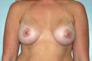 Breast Augmentation Patient 141