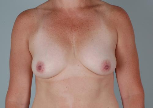 Breast Lift with Augmentation Patient 162