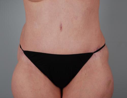 Tummy Tuck Patient 168