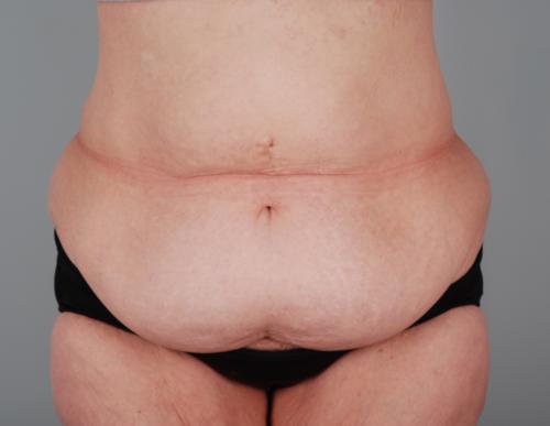 Tummy Tuck Patient 168