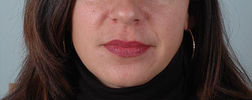 Juvederm Patient 173