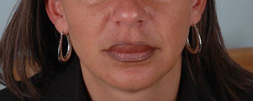 Juvederm Patient 173