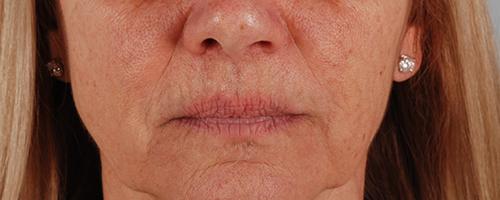 Juvederm Patient 174